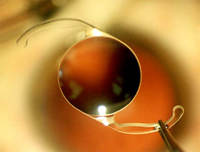 A close-up of IOL being held by tweezers over an eye.