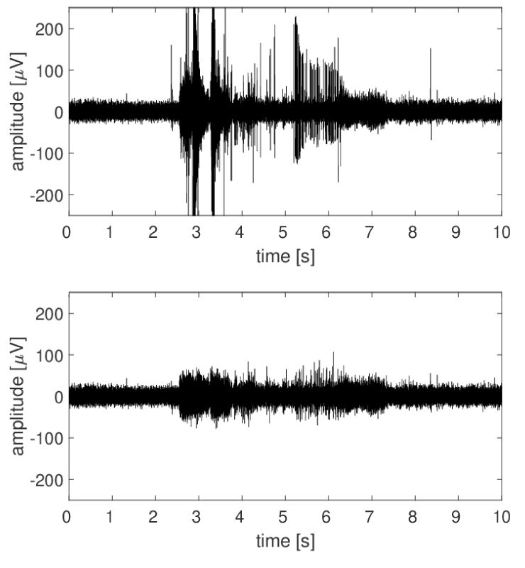 Top image: A graph with time on the x-axis and amplitude on the y-axis. Signal spikes range from -200 to +200 amplitude.  Bottom image: A graph with time on the x-axis and amplitude on the y-axis. This signal is much flatter in amplitude without the severe spikes.