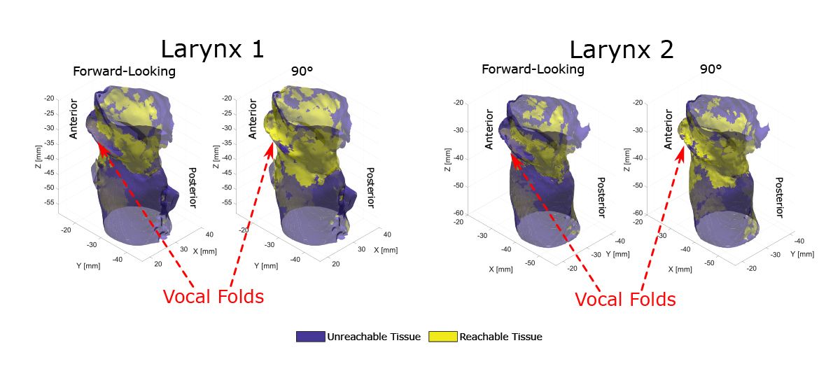 Simulations du larynx qui comparent les zones accessibles par les fibres orientées vers l’avant par rapport aux fibres à 90° et démontrent que la fibre à 90° atteint une plus grande surface.