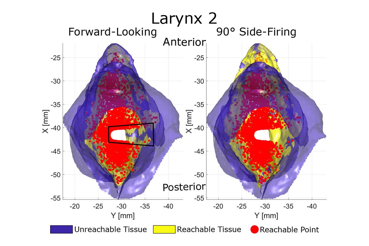 Simulations du larynx qui comparent les zones accessibles par les fibres tournées vers l’avant par rapport aux fibres à tir latéral à 90° et montrent la zone qui n'était auparavant pas disponible pour les fibres tournées vers l'avenir. 