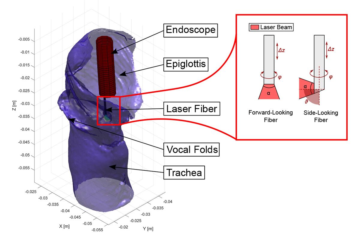 Une simulation du larynx montrant l'endoscope inséré, l'épiglotte, les cordes vocales et la trachée. Le modèle laser de droite montre que la fibre orientée latéralement a jusqu'à 90 degrés de mouvement par rapport à la fibre orientée vers l'avant.