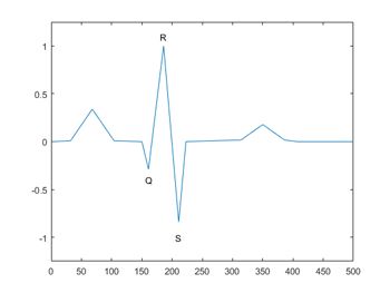 Figure 2.  A QRS complex from an ECG signal.