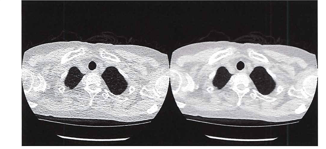 Figure 1. Comparing the image quality of ultra-low-dose CT with a traditional CT.