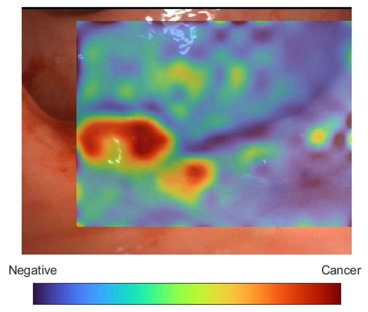 Une image de polype du côlon est affichée avec une superposition à code couleur indiquant la probabilité prédite par l'IA qu'une région soit cancéreuse ou non cancéreuse.