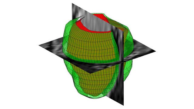 Three dimensional geometrical reconstruction of the human left ventricle from MR images.  Three dimensional geometrical reconstruction of the human left ventricle from MR images.