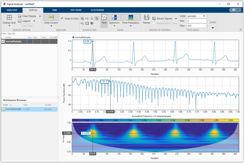 Classify Ecg Signals In Simulink Using Deep Learning Matlab Simulink ...