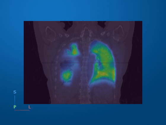 A PET and CT scan fusion image illustrating medical image processing with color-coded regions.