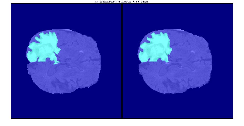 Brain MRI showing tumor tissue segmented using medical image processing.