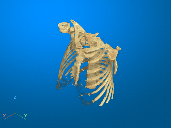 Chest CT display after bed removal