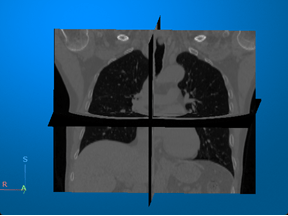 CT volume displayed as anatomical slice planes using the volshow function