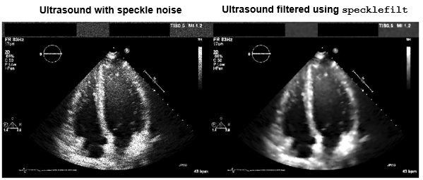 Ultrasound image before and after denoising by using the specklefilt function