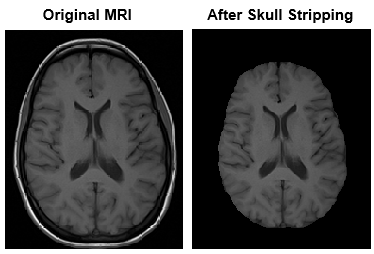 Brain MRI image after skull stripping