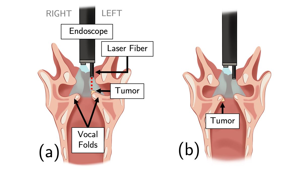 Simuler la chirurgie en 3D pour le design de nouveaux dispositifs médicaux