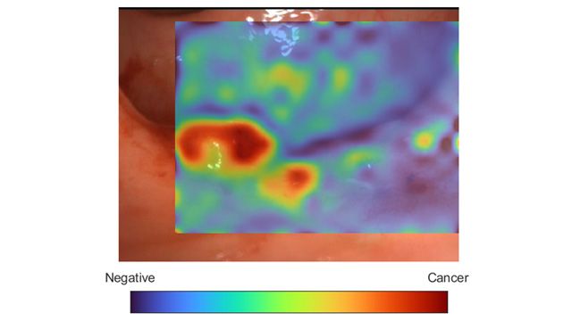 Améliorer le diagnostic du cancer en temps réel grâce à l'IA