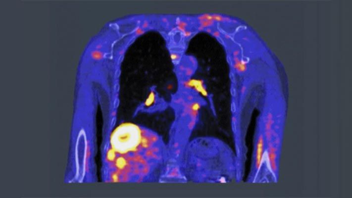 Une thérapie ciblant le cancer en temps réel